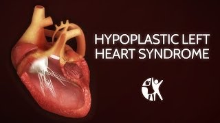 Hypoplastic Left Heart Syndrome HLHS [upl. by Assirual]