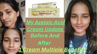 My Azelaic Acid Cream 10 Update  Before And After  Azidem Cream  1 Cream Multiple Benefits [upl. by Gilder]