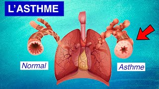 Asthme bronchique  Physiopathologie Symptômes et Traitements [upl. by Ymmij]