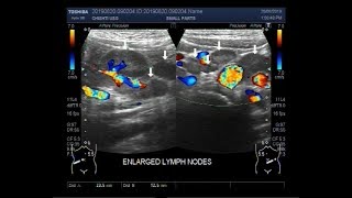 Ultrasound Video showing Mesenteric lymphadenitis with an inflamed gut loop [upl. by Calhoun40]