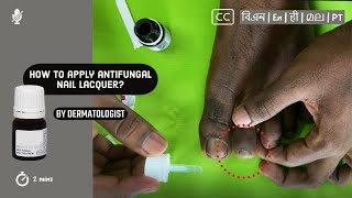 💅 How to apply antifungal nail lacquer to nail fungus  by Dermatologist [upl. by Nodnas]