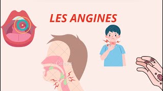 Angines  Types Symptômes et Traitements – Tout ce quil Faut Savoir [upl. by Namara]