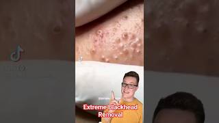 EXTREME BLACKHEAD REMOVAL  Blackhead Popping At Its Best shorts [upl. by Titus]