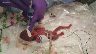 World’s smallest surviving baby born in San Diego [upl. by Rudich63]