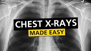 Chest X Rays CXR Made Easy  Learn in 10 Minutes [upl. by Ahsatan695]