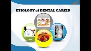 Dental cariesEtiology and Pathogenesis [upl. by Slen101]