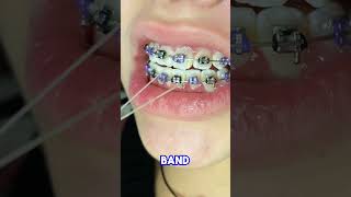 Rubber bands in braces  Toothtime Family Dentistry New Braunfels  Orthodontic Treatment 107 [upl. by Og317]