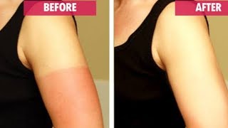 Natural Remedies for Sunburn How to remove Sunburn Naturally [upl. by Aritak]