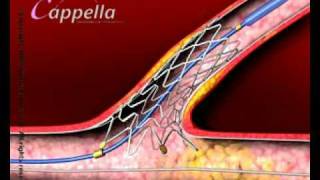 Stent insertion [upl. by Flavian]