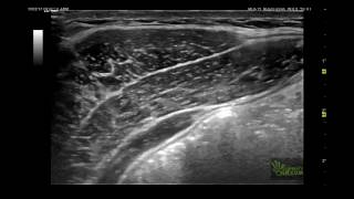 Contracción del transverso abdominal [upl. by Irem]