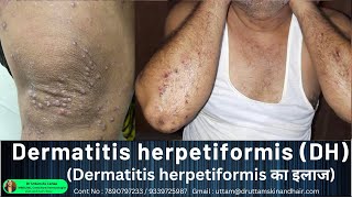 Dermatitis herpetiformis DH का इलाज  Itching water filled rashes on elbow knee Dr Uttam Lenka [upl. by Oivaf]