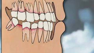 Dental Implants Pros amp Cons  YOU MUST SEE IT [upl. by Ahsikcin]