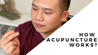 What is Acupuncture And does it Work [upl. by Frankhouse]