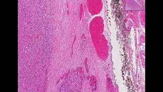 Histopathology ThyroidFollicular carcinoma [upl. by Einna]