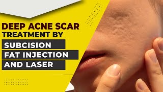 Deep Acne Scar Treatment Laser Fat Injection and Subcision  Acne Scar Treatment in Delhi [upl. by Ytsihc]