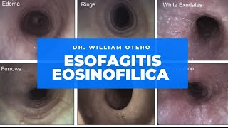 Esofagitis Eosinófilica Cómo diagnósticarlo y tratarlo en el 2021 [upl. by Ken]