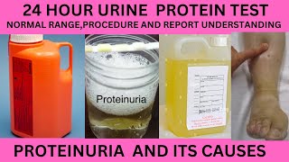 24 HOUR PROTEIN TESTIN URINENORMAL RANGEPROCEDURE AND REPORT24 HOUR URINE PROTEIN COLLECTION [upl. by Watanabe]