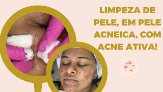 Limpeza de pele profissional em pele acneica com acne ativa [upl. by Dyraj]