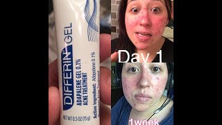 Differin gel acne treatment part 1 [upl. by Elahcar]