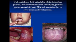 pathology  Dr Dhaymaa  Oral lesions amp Salivary gland Pathology [upl. by Llain531]