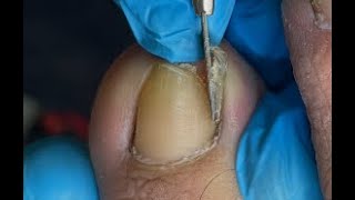 Ingrown Toenail A Quick Fix With Dental Floss [upl. by Wellington]