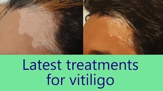 Cure White Patches on Skin  Advance Treatment For Vitiligo  Dr Rinky Kapoor [upl. by Antoine]