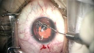 EyeCryl Phakic IOL Implantation  Routine Surgery [upl. by Intosh]