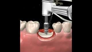 Step by step dental implant surgery Gary R OBrien DDS [upl. by Reynard]