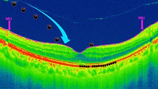 Estructura de la Membrana Epirretiniana [upl. by Ziana370]