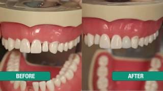 Uveneer Peg Lateral and Diastema Closure [upl. by Egduj]