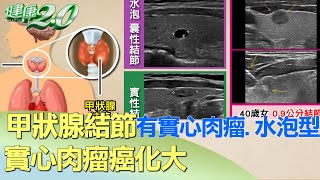 甲狀腺結節有實心肉瘤水泡型 實心肉瘤癌化大 健康20 [upl. by Nylarad]