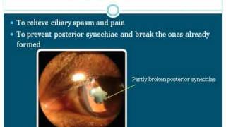 Ophthalmology  Uvea Class4 Management of uveitis Part1 [upl. by Warfeld547]