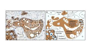 XMRV a New Human Retrovirus Lecture 25 [upl. by Alaekim]