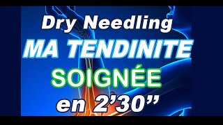 Dry Needling  ma tendinite au coude soignée en 230 [upl. by Auohs]