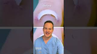 How to remove an Ingrown Toenail 😳shorts [upl. by Yahsram]