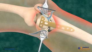 High Tibial Osteotomy HTO for Bow Leg Correction [upl. by Ahseryt529]