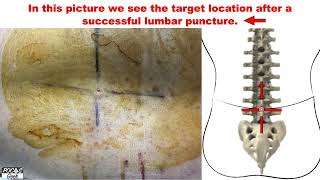 POCUS Ultrasound Guided Lumbar Puncture [upl. by Atteuqaj]