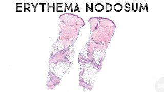 Erythema nodosum panniculitis subcutaneous nodules fat necrosis dermatology pathology dermpath [upl. by Plumbo]