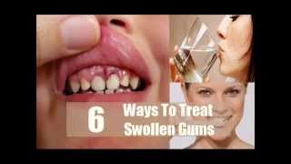 6 How To Treat Swollen Gums [upl. by Nais438]