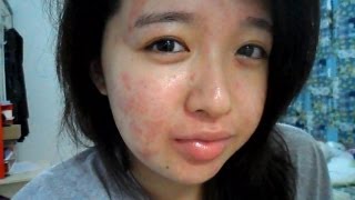 My Acne Story 15th Week of Accutane [upl. by Manchester964]