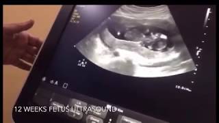 12 Weeks Pregnancy Ultrasound Baby moving [upl. by Ahsiad768]