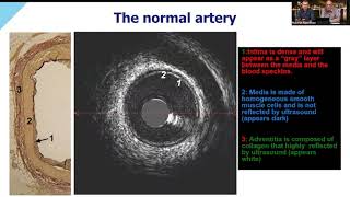 Optimizing PCI Using FFR and HD IVUS Part 2  The Benefits of IVUS in Acute Coronary Syndrome [upl. by Diane292]