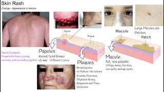 Understanding Rash in 3 minutes Skin Rash types and causes [upl. by Eilloh]