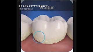 Stage 1 of Tooth Decay Demineralization [upl. by Waine705]