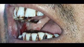 Verrucous hyperplasiaVerrucous carcinoma buccal mucosa  Dr Hitesh Patel [upl. by Aicilana477]