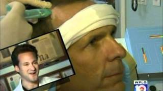 Ouchless Hair Transplant  Dr Alan Bauman [upl. by Merna274]