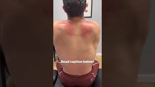 Muscle Scraping By a NYC Chiropractor getadjusted chiropractor neckcrack [upl. by Kwapong]