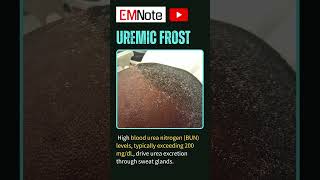 Uremic Frost of ESRD nursing doctor medical [upl. by Alehtse]