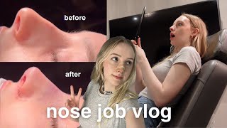 nose job vlog  rhinoplasty recovery amp results [upl. by Gebhardt771]