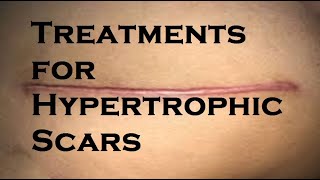 Treatments for Hypertrophic Scars [upl. by Ohare]